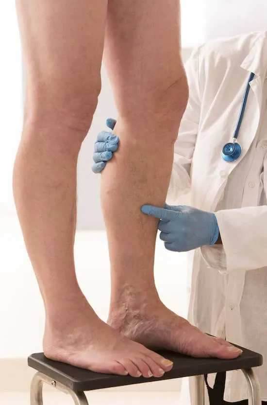 Úlceras Venosas